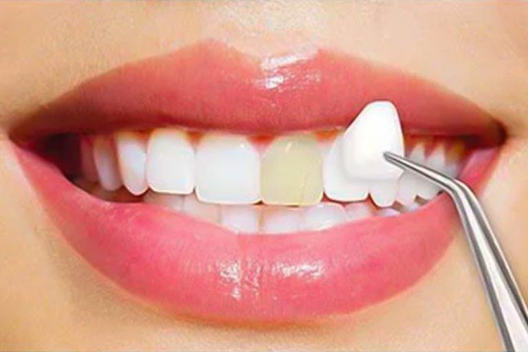 Restore Your Tooth Through Veneer Services In Toronto