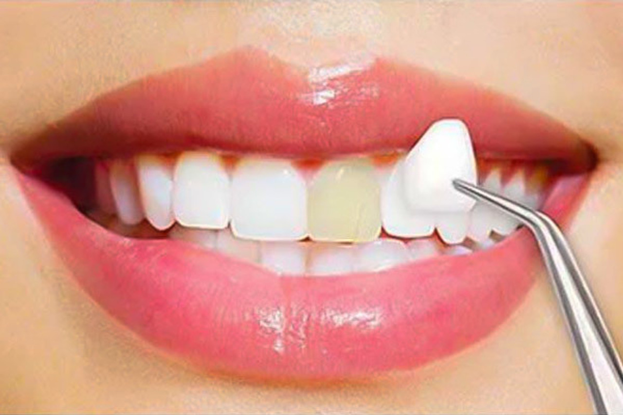 Veneers in Toronto