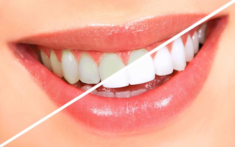 Lighten Your Smile With Professional Teeth Whitening Services