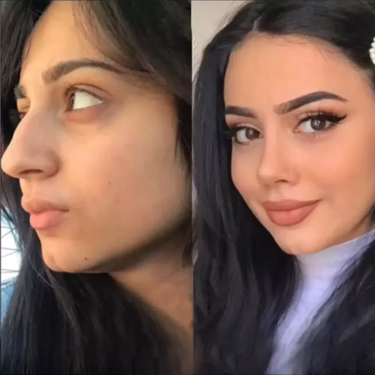 Rhinoplasty in Dubai: Essential Steps and Considerations