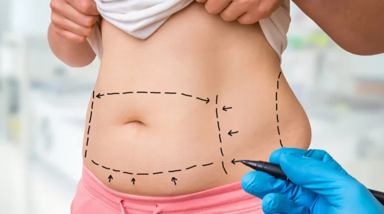 Everything You Need to Know About Liposuction in Dubai