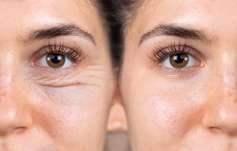 Age Related Changes and Blepharoplasty When to Consider Surgery