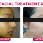 Hydrafacial for Skin