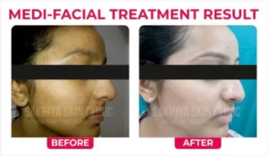 Benefits of Hydrafacial for Skin – The Secret to Effortless Glow